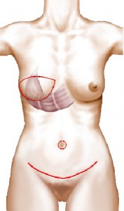 chirurgie mammaire grand droit abdominal